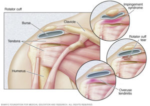 Rotator Cuff Injury Technical