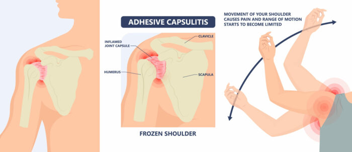 Adhesive Capsulitis Chart