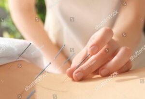 Acupuncture