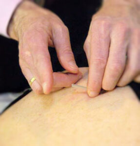 Acupuncture Treatment