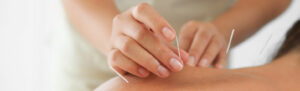Acupuncture session